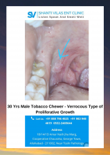 30 Yrs Male Tobacco Chewer - Verrocous Type of Proliferative  Growth